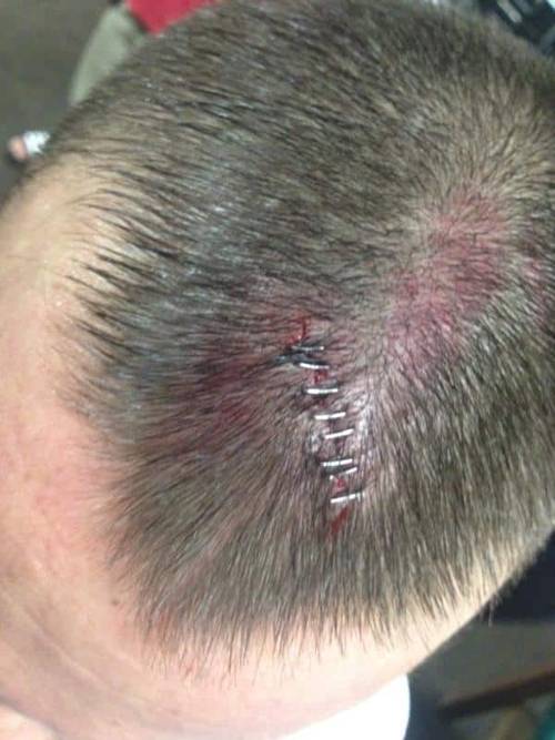 CM Punk con una herida en la cabeza tras su combate contra Jerry Lawler