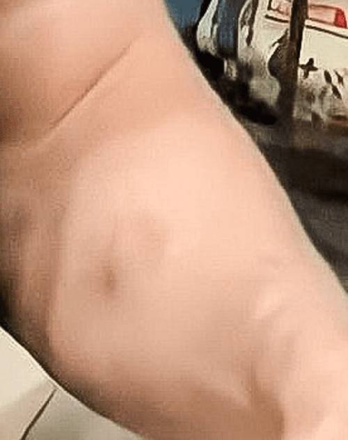 El brazo supuestamente mordido de Kenny Omega